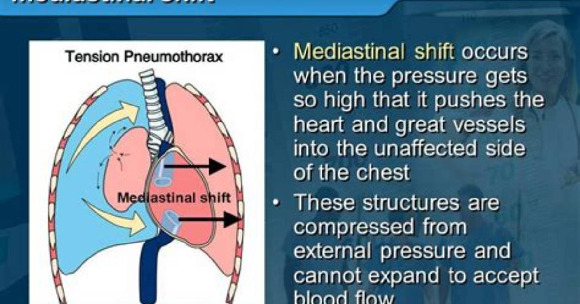 Why Is a Mediastinal Shift?
