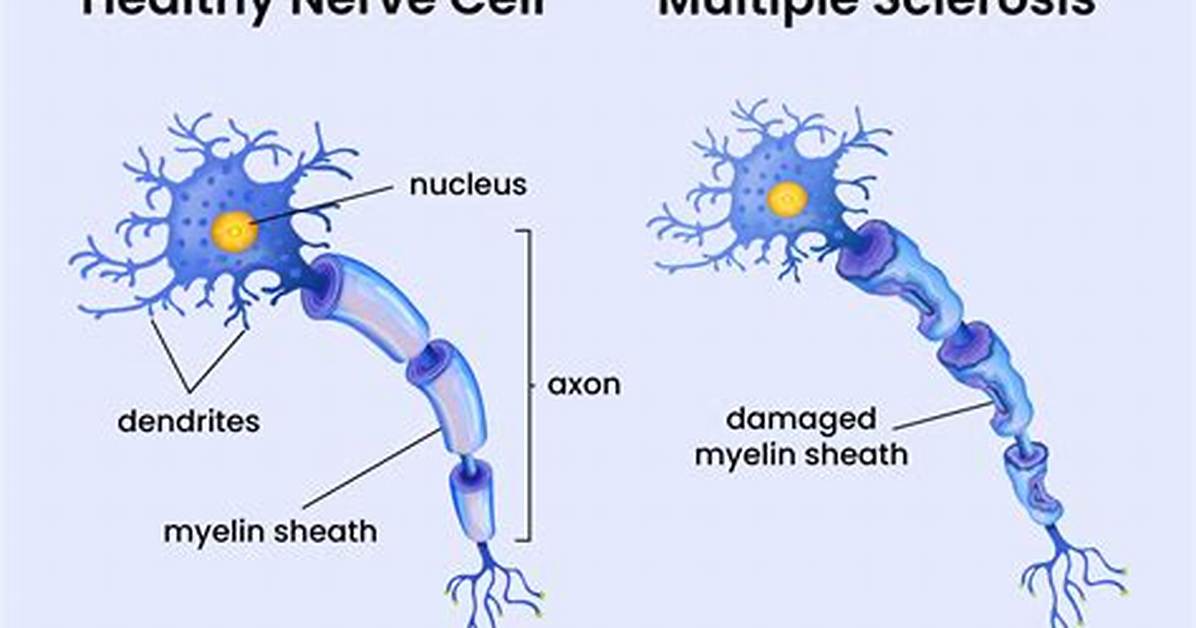 Why Is Benadryl Great for Multiple Sclerosis?