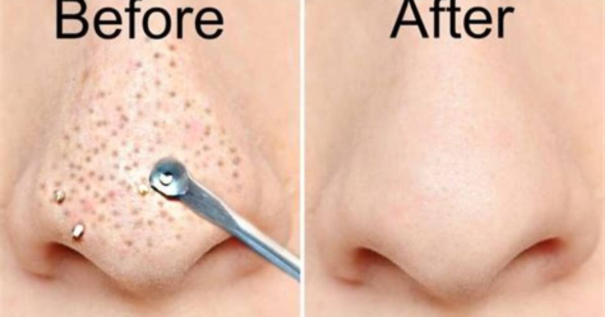 Why Is Blackhead Removal Satisfying?