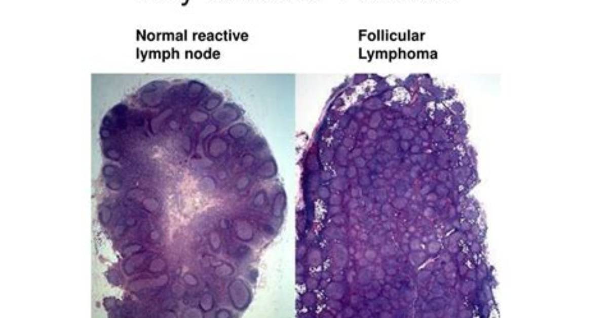 Why Is Follicular Lymphoma Called Follicular