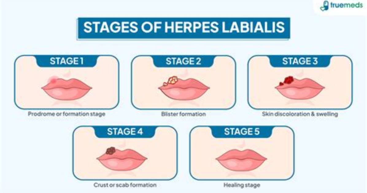 Why Is Herpes Labialis Called Cold Sores?
