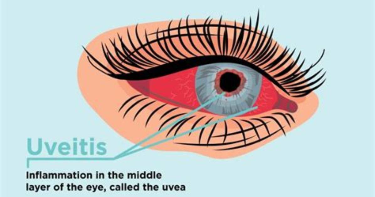 Why Is Iritis Caused?