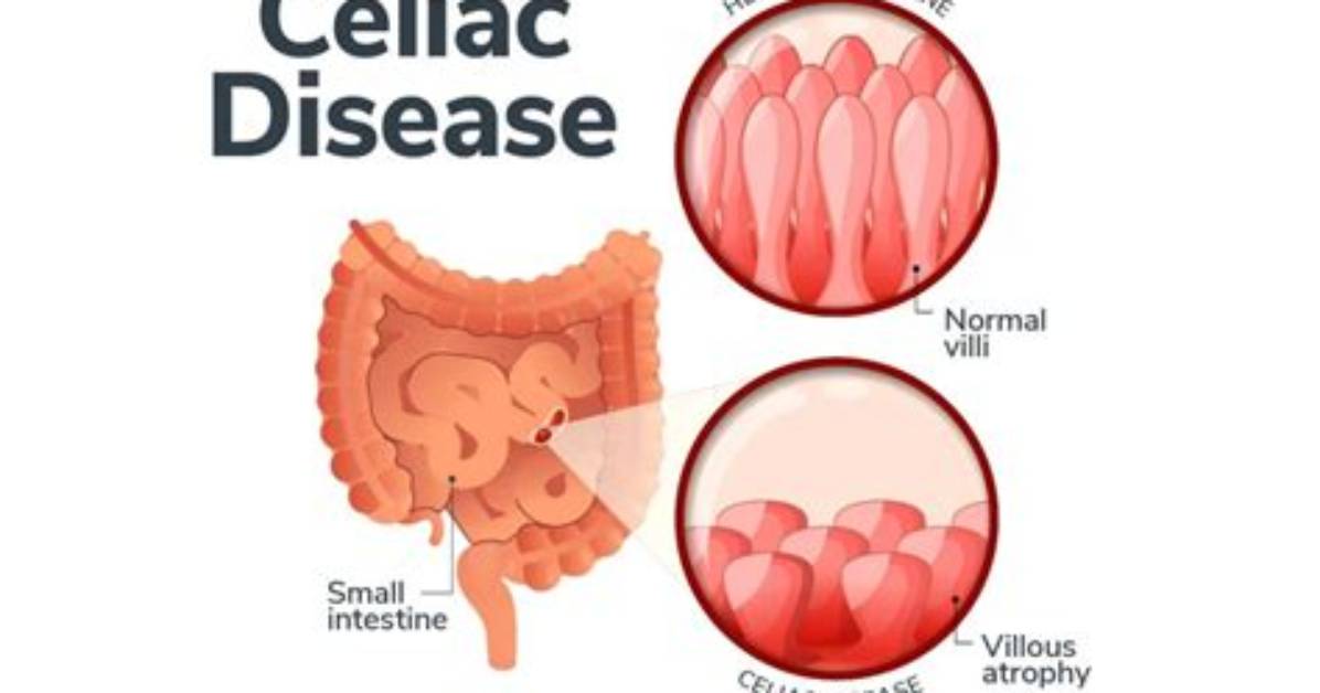 Why Is It Called Celiac