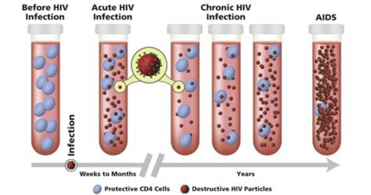 Why Is It Called Full Blown Aids?