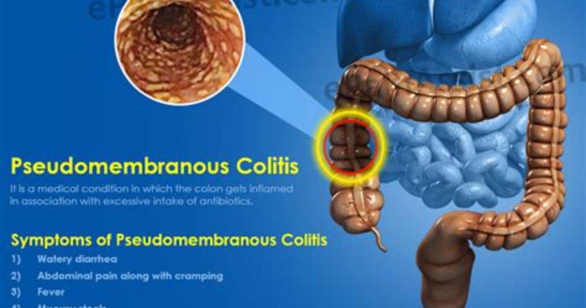 Why Is It Called Pseudomembranous Colitis?