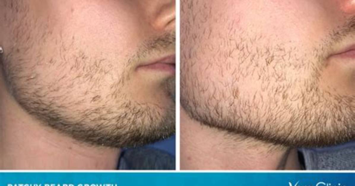 Why Is My Beard Patchy?
