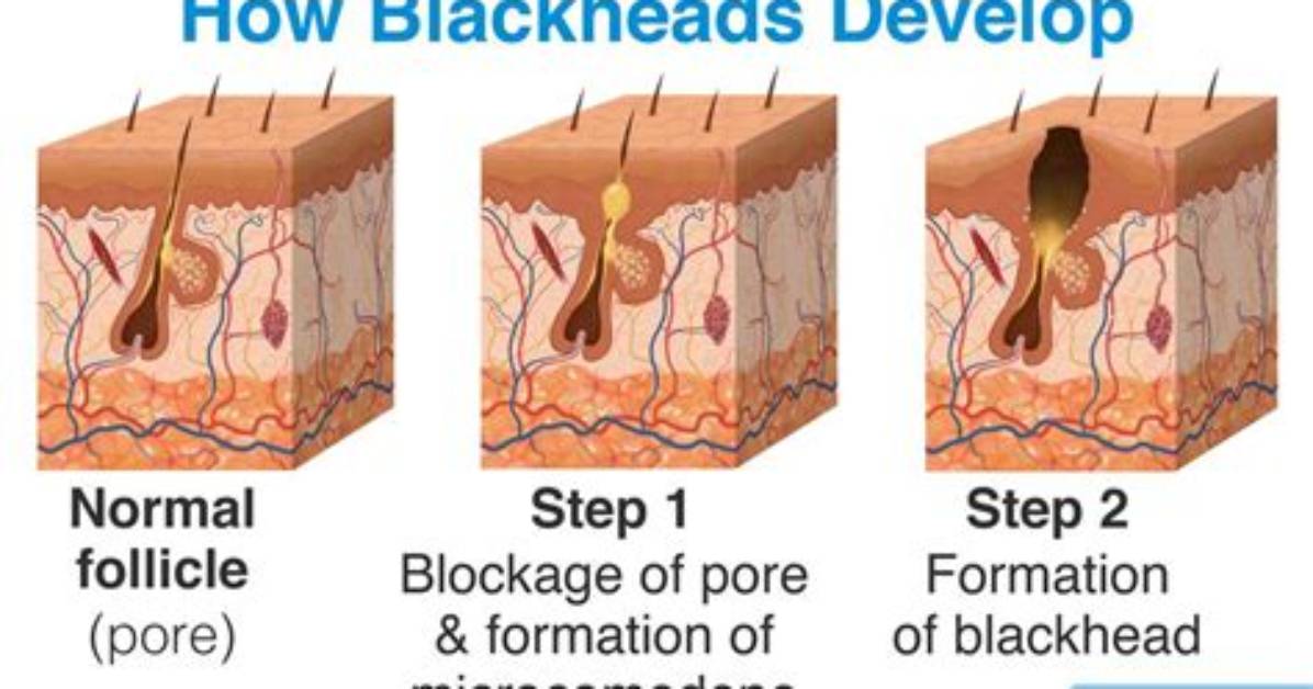 Why Is My Blackhead Bleeding?