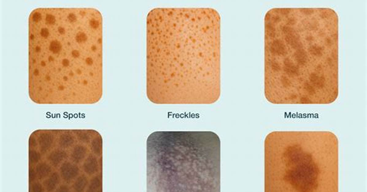 Why Is My Pigmentation Spreading?