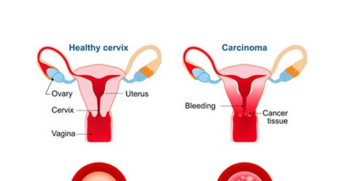 Why Is Pap Smear Done?