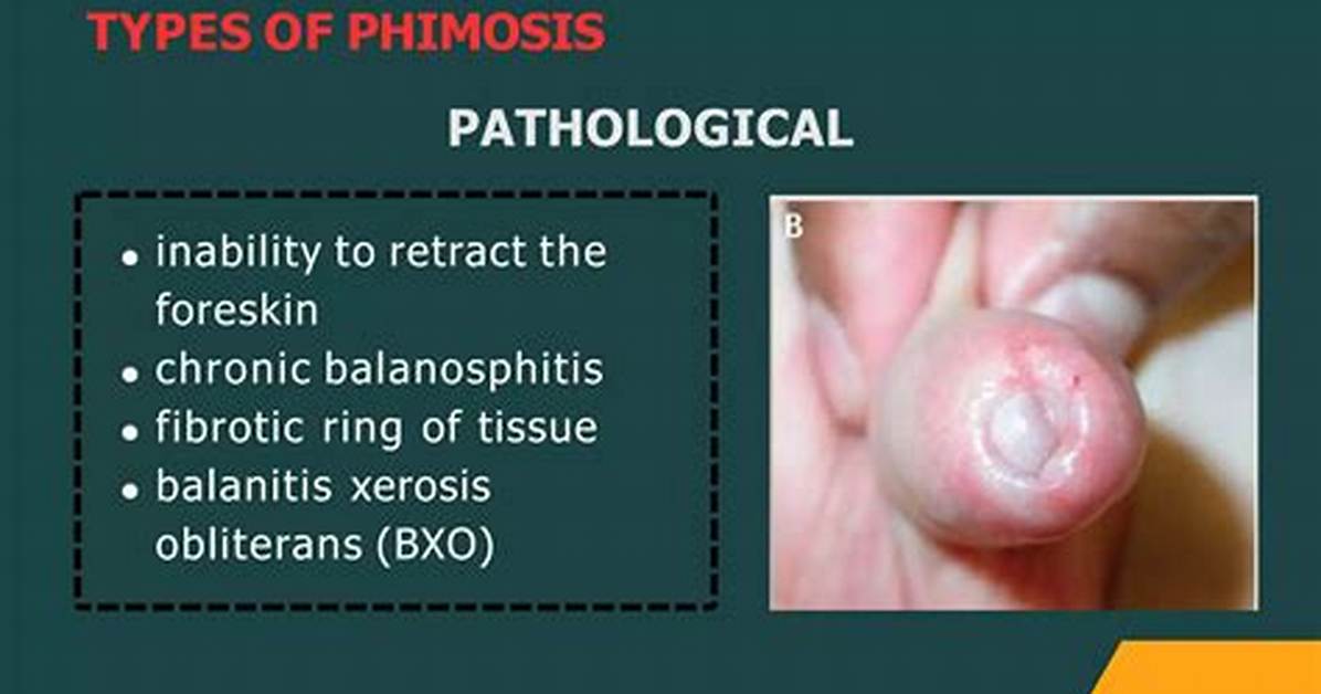 Why Is Phimosis a Problem?