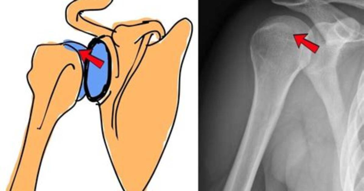 Why Is Posterior Shoulder Dislocation Rare