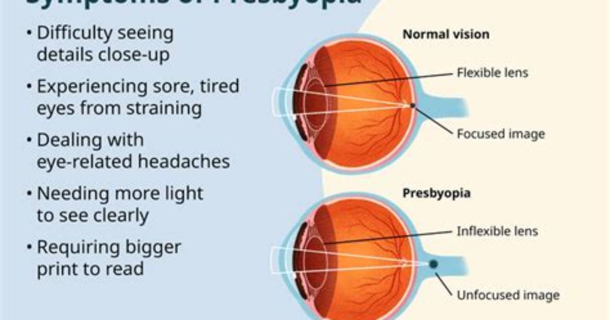 Why Is Presbyopia Not a Refractive Error?