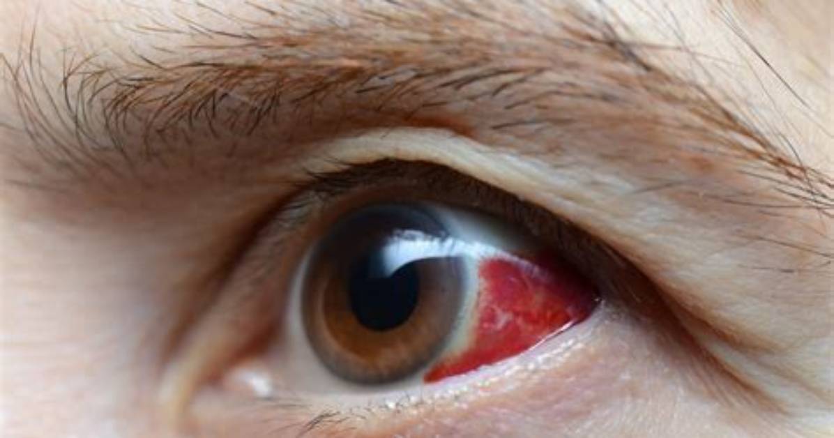 Why Is Red Eye Catching?