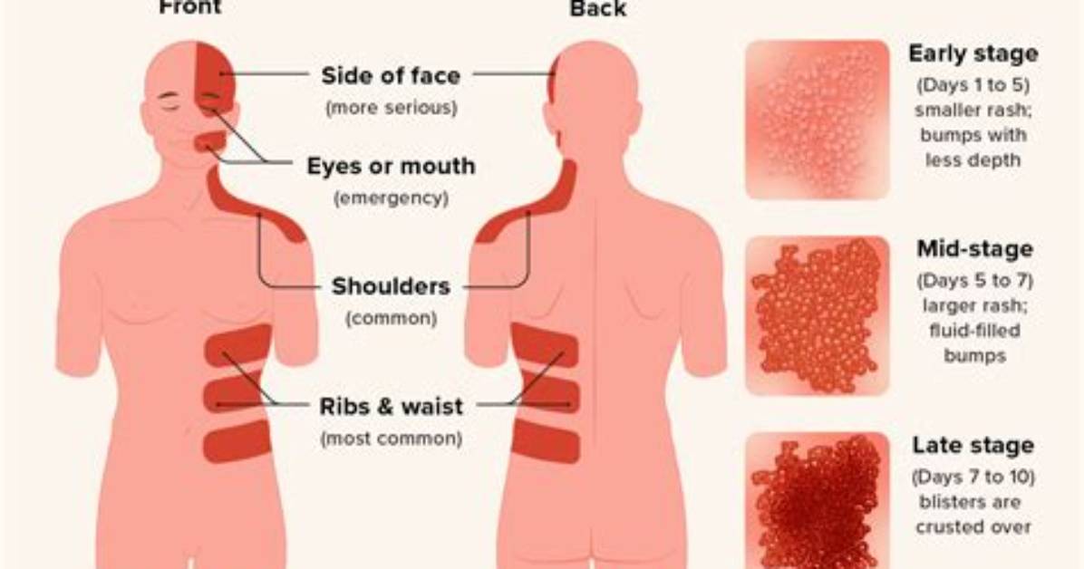 Why Is Shingles Localized?