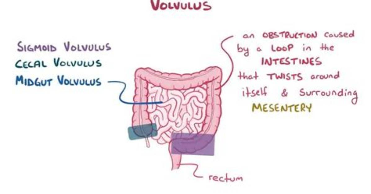 Why Is Sigmoid Volvulus More Common?