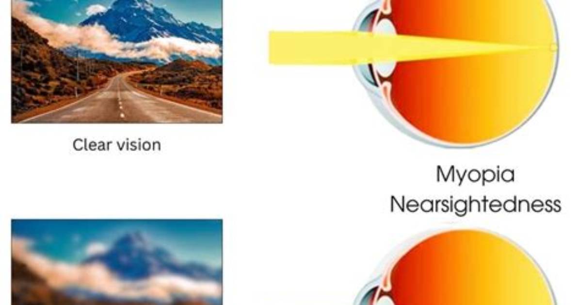 Why Is Someone Nearsighted?