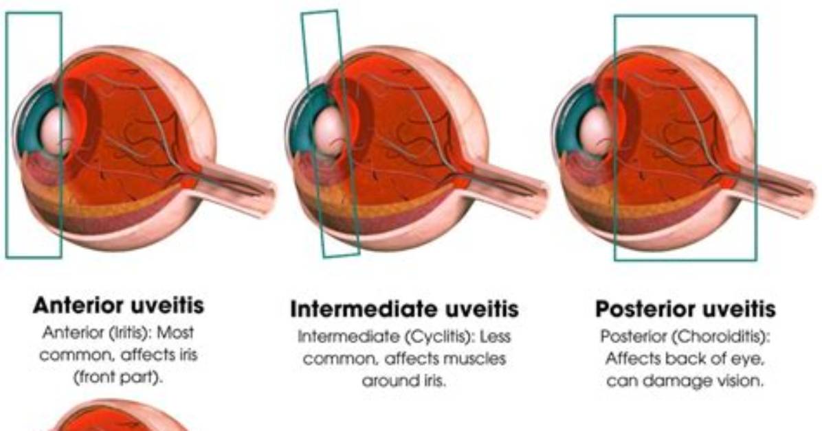 Why Is Uveitis Painful?