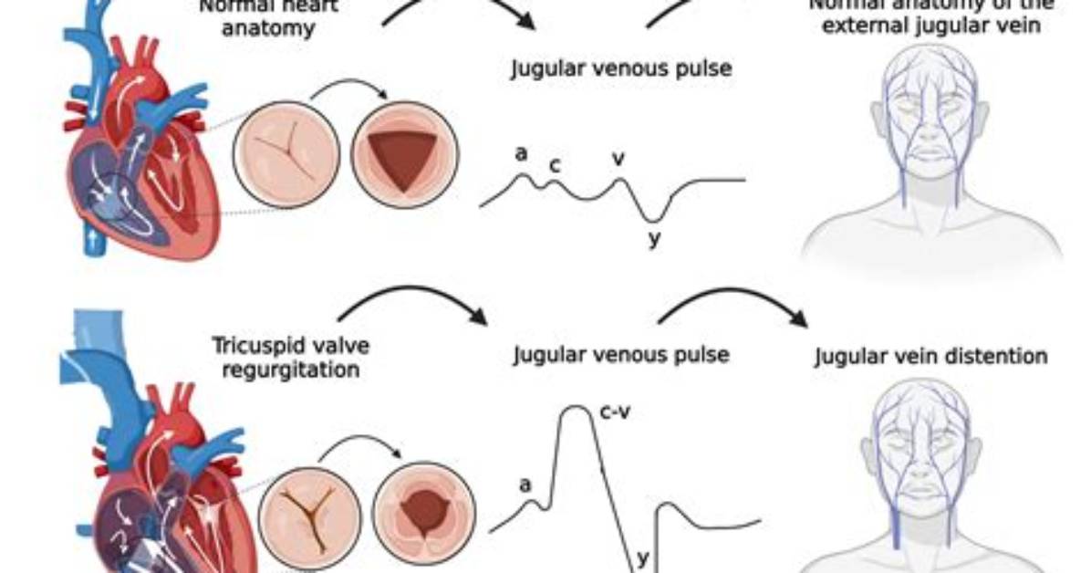 Why Jugular Vein Distention?