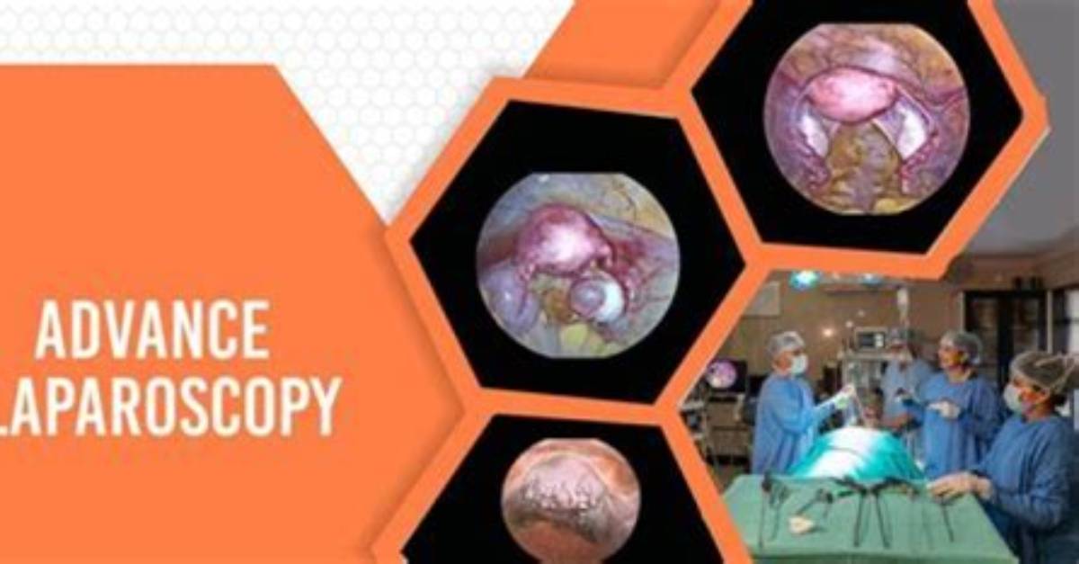 Why Laparoscopy Is Done?