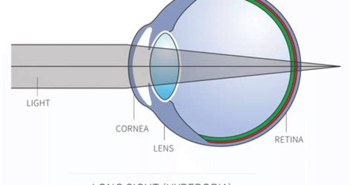 Why Long Sightedness Occurs?