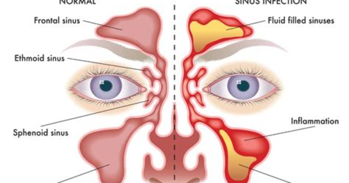 Why Maxillary Sinusitis Is Common?