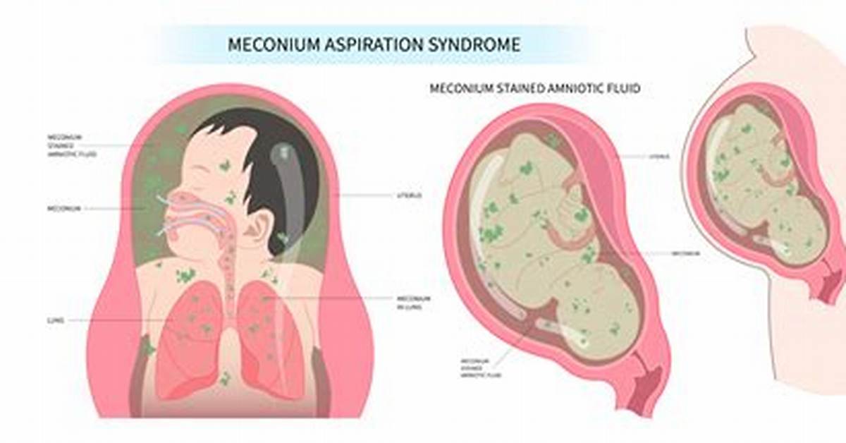 Why Meconium Is Bad?