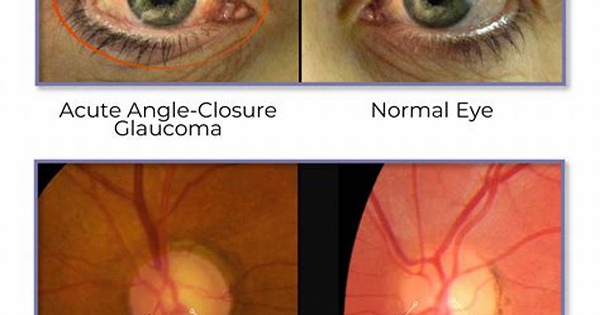 Why Pupil Is Vertically Oval in Glaucoma?