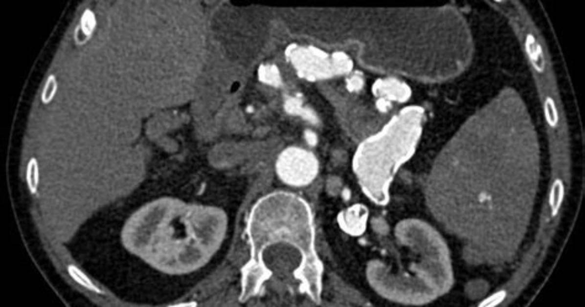 Why Splenic Artery Is Tortuous?