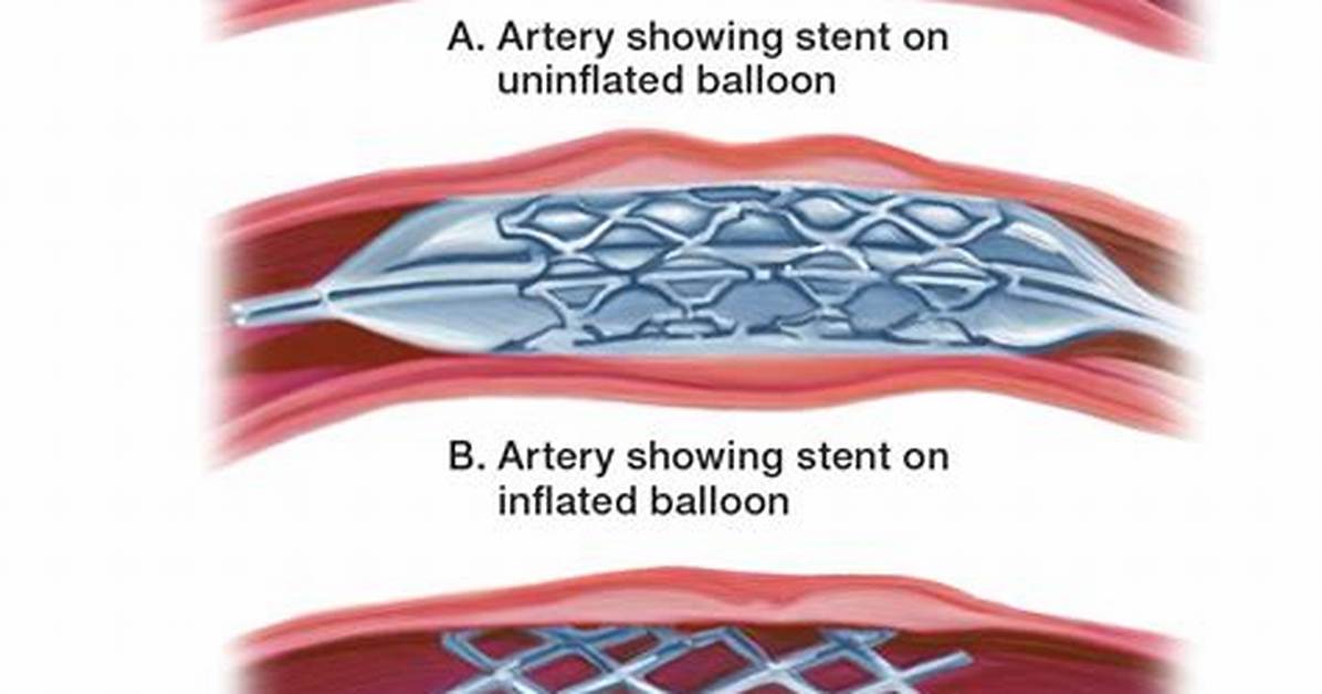 Why Stent Is Important?