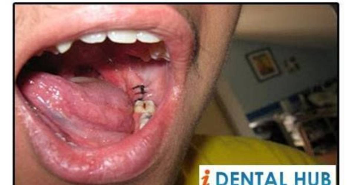 Why Sutures After Tooth Extraction?