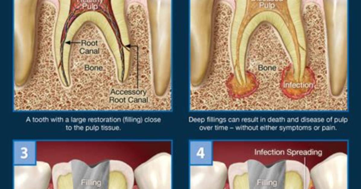 Why Tooth Root Pain?