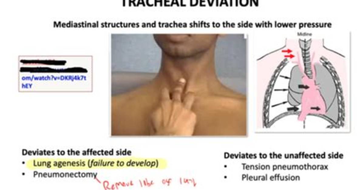 Why Trachea Is Deviated to Right Normally?