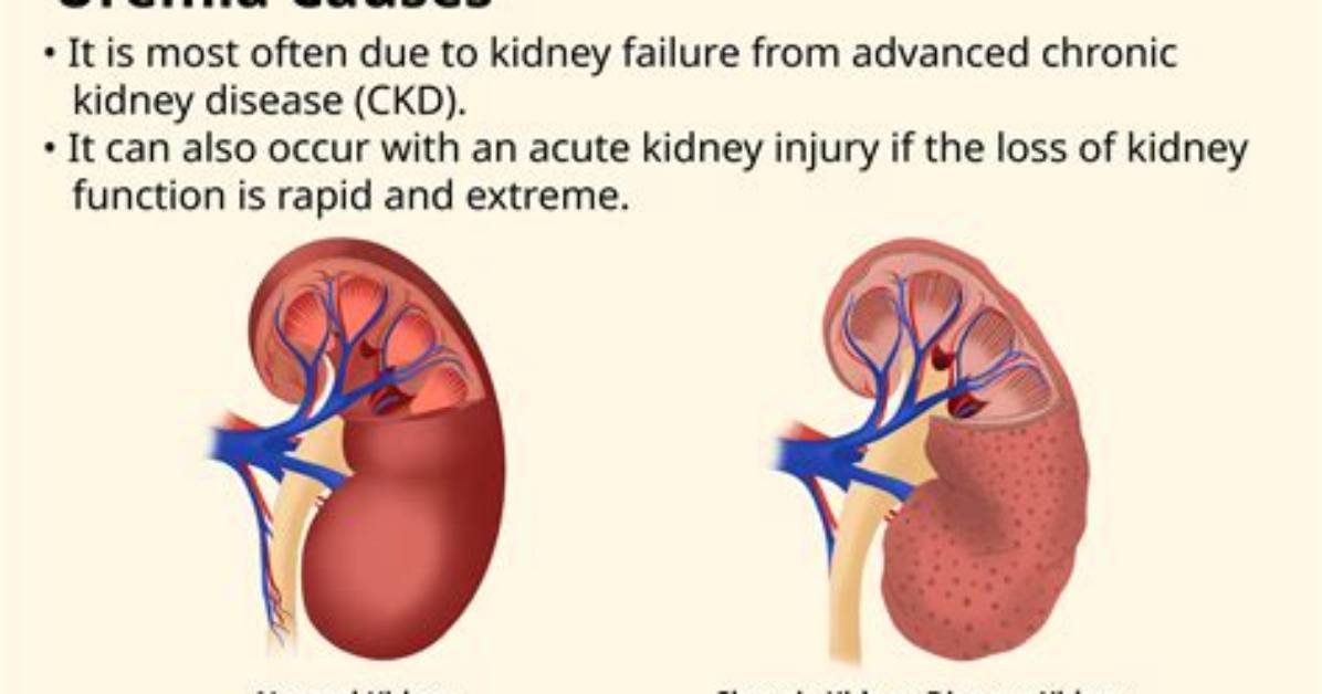 Why Uremia Cause Vomiting?