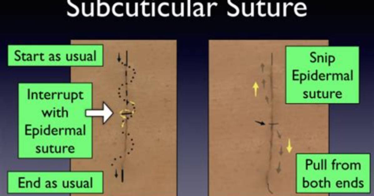 Why Use Subcuticular Suture?