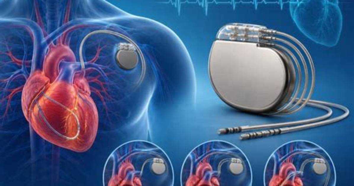 Why Would a Person Need a Pacemaker?