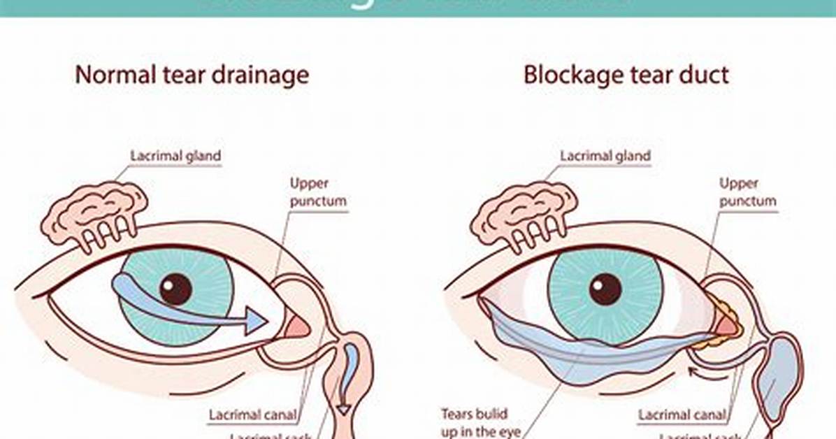 Will a Blocked Tear Duct Fix Itself?
