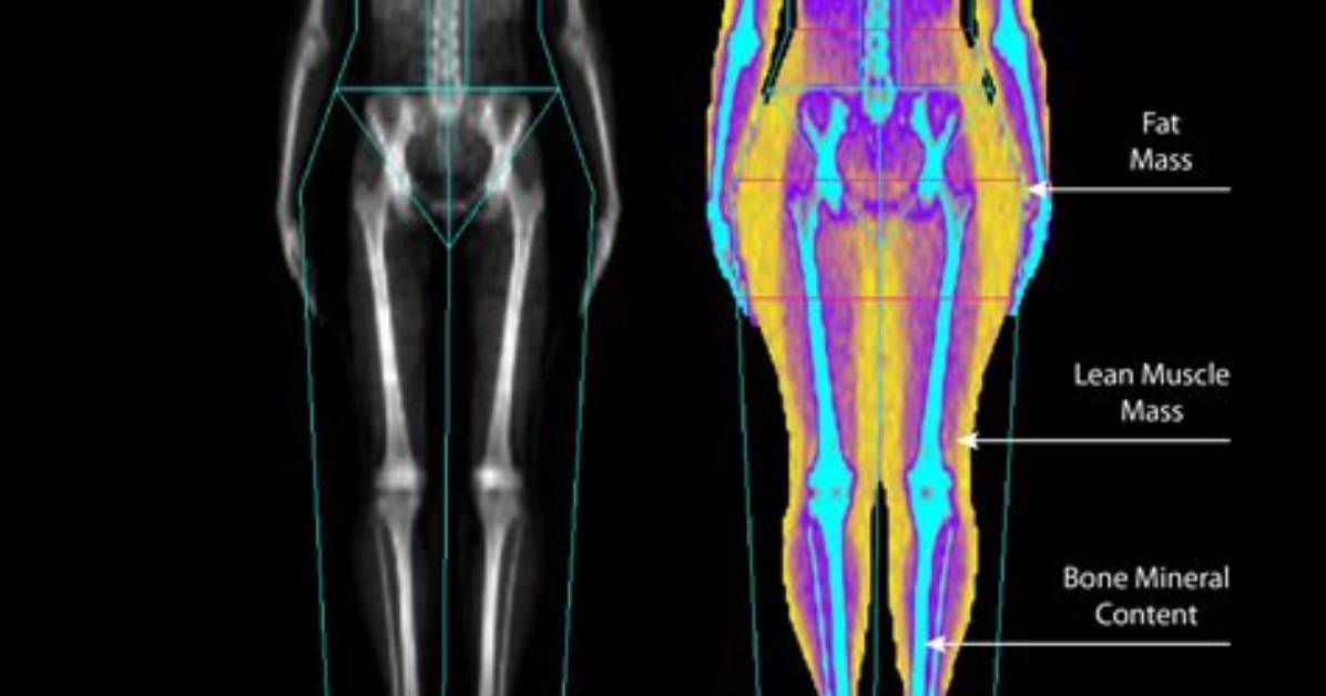 Will a Bone Scan Show Osteoporosis?