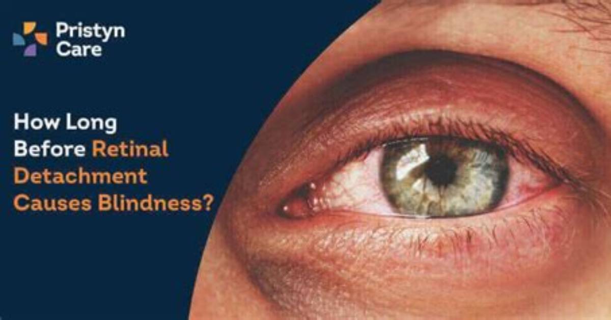 Will a Detached Retina Cause Blindness?