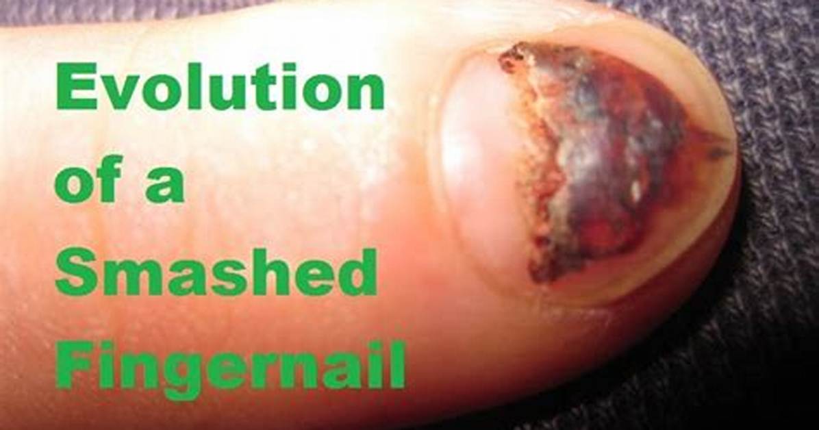 Will a Smashed Fingernail Grow Back?
