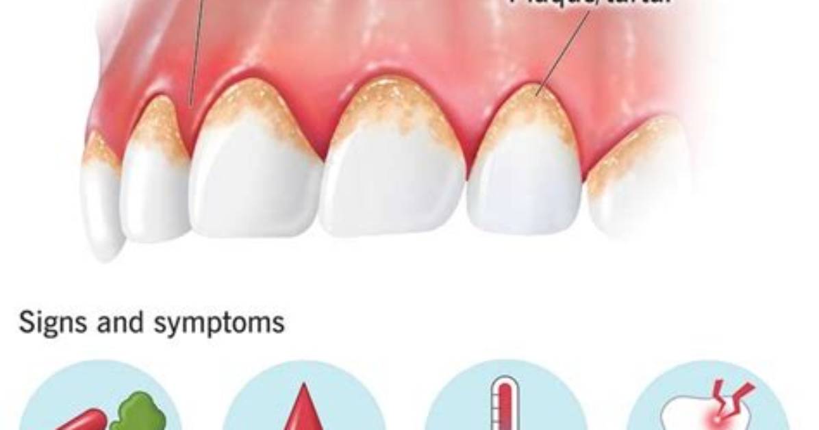 Will Antibiotics Help Gingivitis?