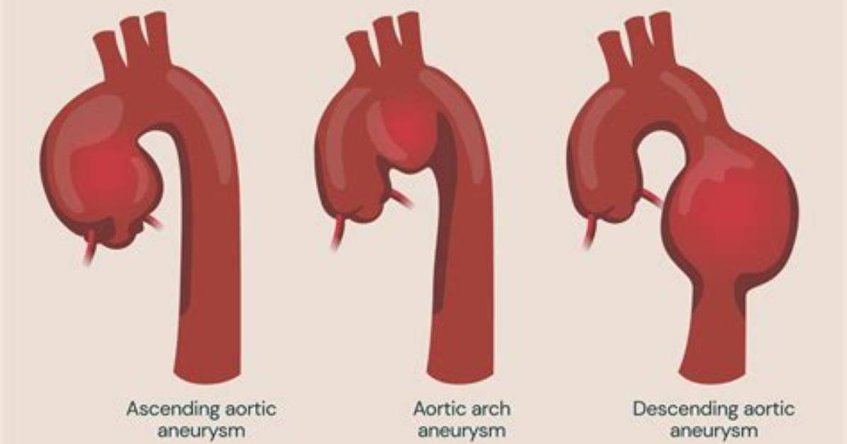 Will Aortic Aneurysms Go Away?