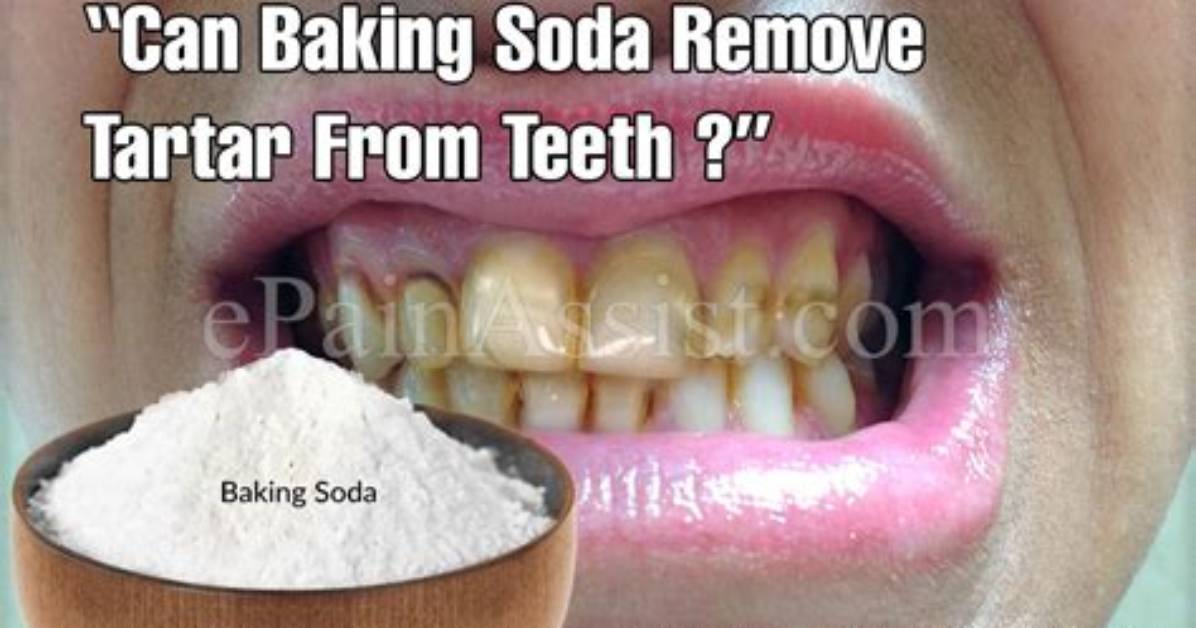 Will Baking Soda Remove Tartar from Teeth?
