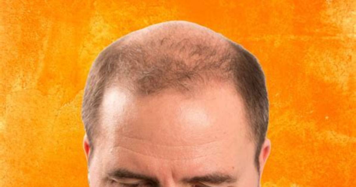 Will Baldness Be Cured by 2025?