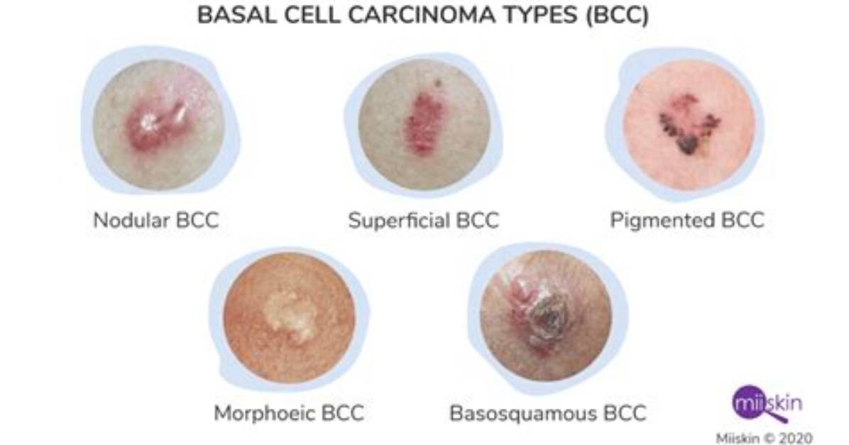 Will Basal Cell Carcinoma Come Back?