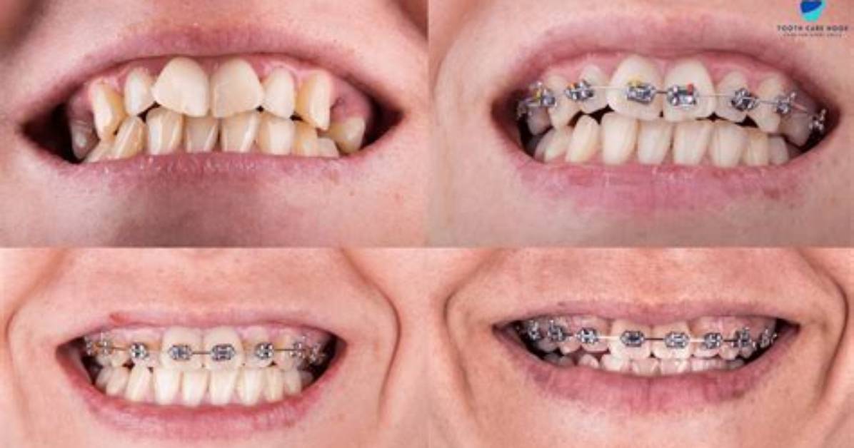 Will Braces Fix My Jaw?