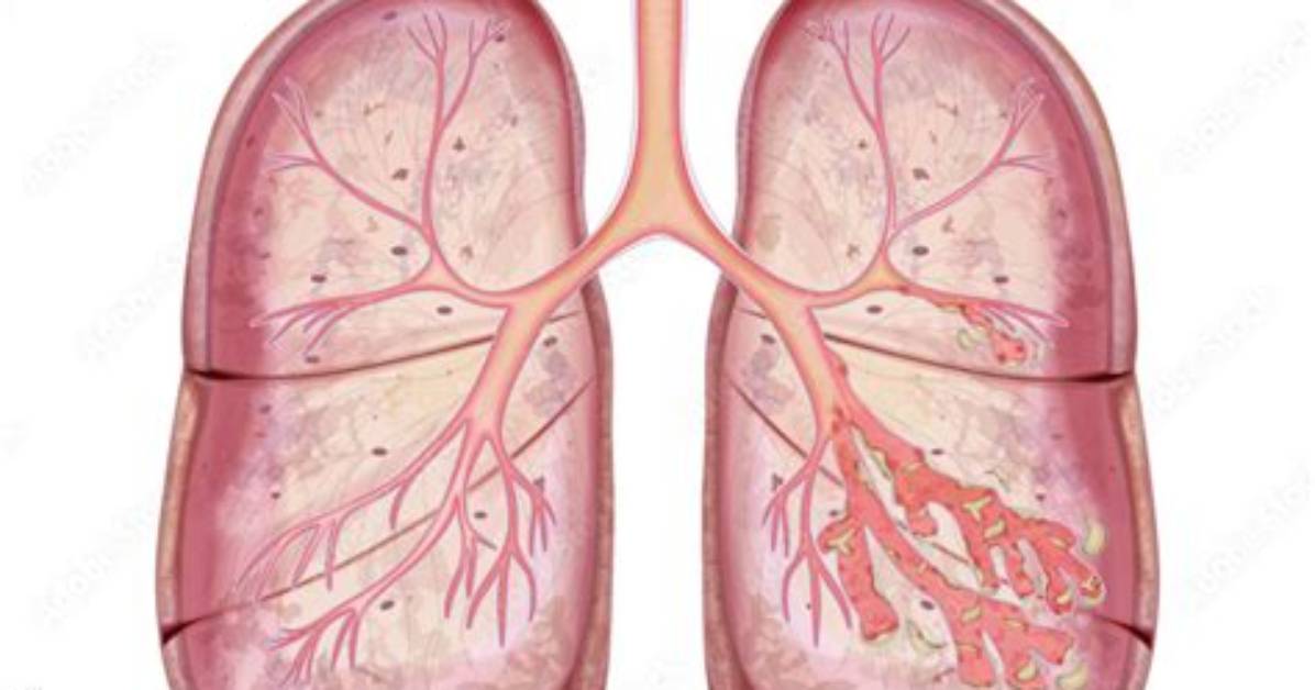 Will Bronchiectasis Kill Me?
