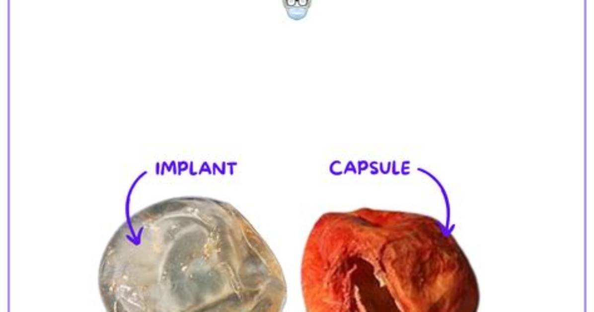 Will Capsular Contracture Go Away?