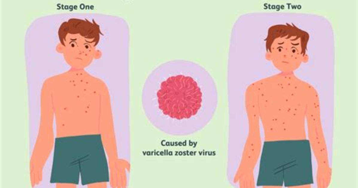 Will Chicken Pox Come Again?