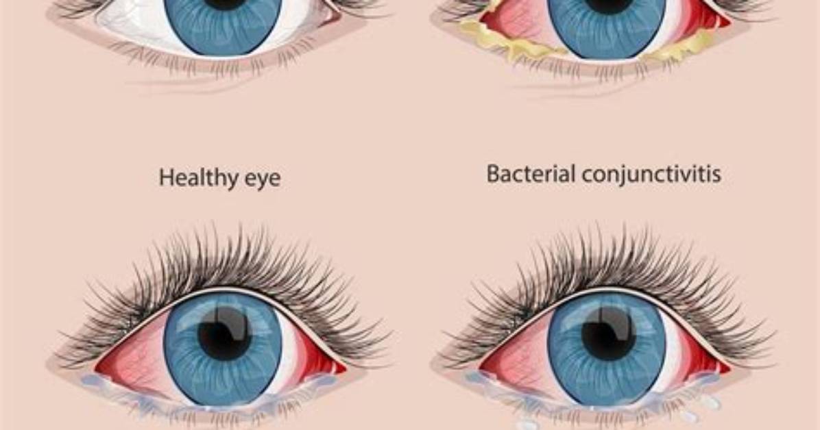 Will Conjunctivitis Go Away?