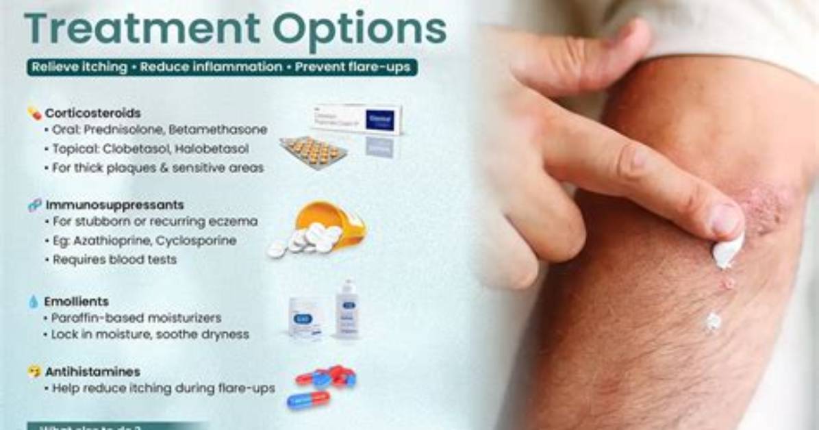 Will Corticosteroids Help Eczema?